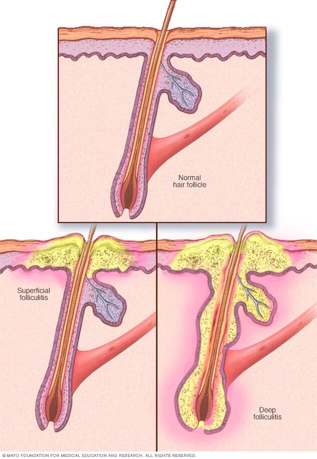 Folliculitis in hair folicle